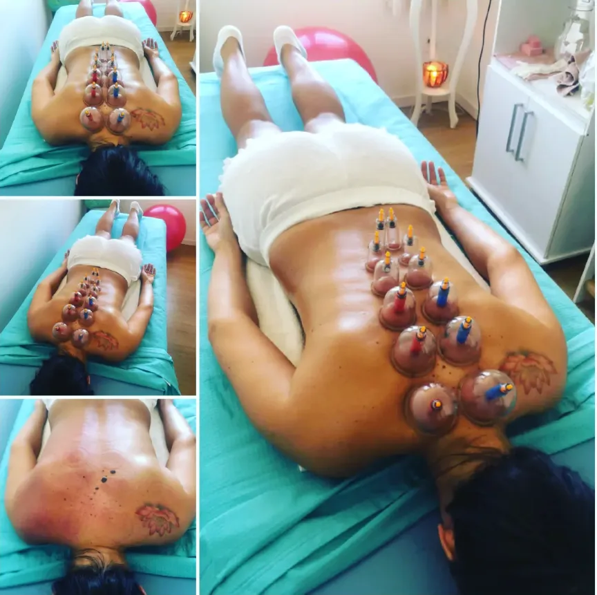 Sesión de ventosas (cupping) en la espalda